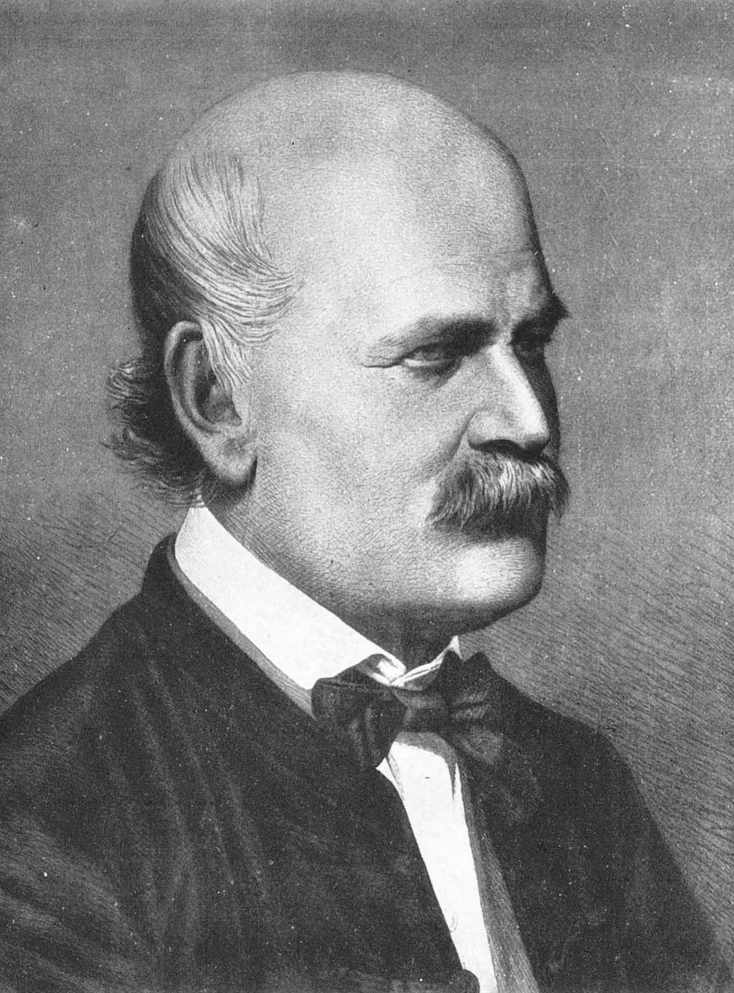 Retrato de Ignaz Semmelweis en 1860, el médico que descubrió la causa de la fiebre puerperal